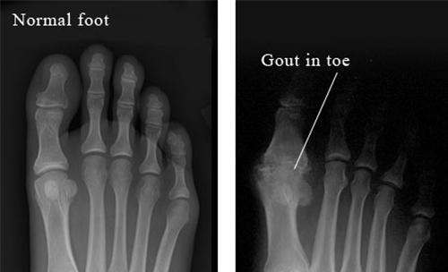Bệnh GOUT đến từ đâu?